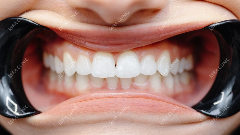 Bite Force and Bruxism